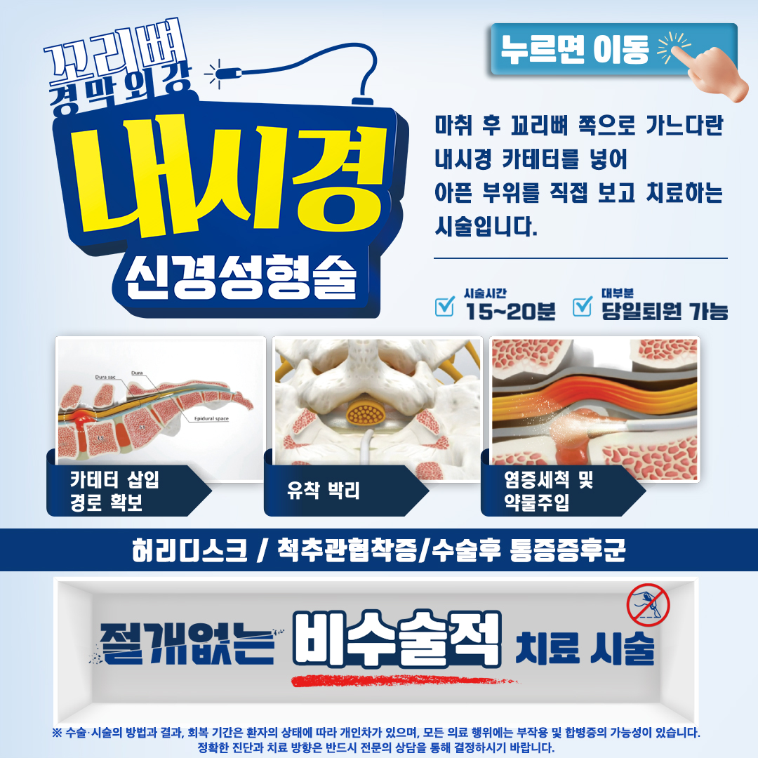 절개없는 비수술적 치료시술, 경막외강 내시경 신경성형술